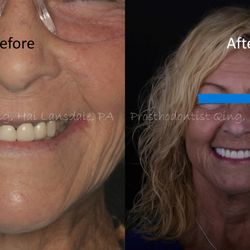 Bucks Dental Health and Esthetics: HAI QING, DMD - Full-mouth restoration to restore health, function and aesthetics