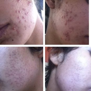 Ava MD - 3 months after Mojan (laser treatment, peels, facials) - Dermatologists Near Me - Santa Monica, California