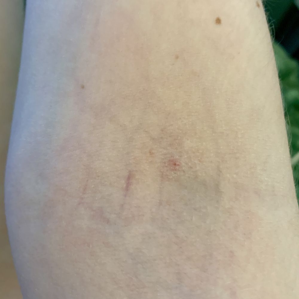 Quest Diagnostics - No bruises on my arm 10 hours after appointment :) - Laboratory Testing Near Me - Darien, Connecticut
