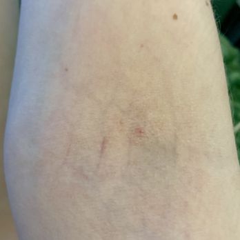 Quest Diagnostics - No bruises on my arm 10 hours after appointment :) - Laboratory Testing Near Me - Darien, Connecticut