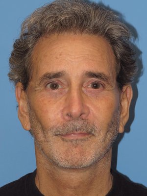 OMG, such a rejuvenated look! - This gentleman desired a more youthful look to the face and neck, more rested-appearing eyes, and an overall treatment for facial aging.   A facial and necklift and eyelid surgery created a completely natural and younger look.    These types of results can really make a difference for our patients!