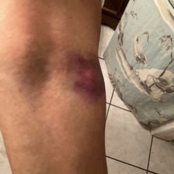 Quest Diagnostics - This was the next day after getting my Blood draw from a guy at quest diagnostics Yesterday.