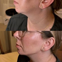 Haus Of Aphrodite - Jaw line filler