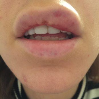 Aesthetic Nurse Megan - Less than 24 hours after lips were white - Cosmetic Surgeons Near Me - Hawthorn, VIC Aesthetic Nurse Megan - Less than 24 hours after lips were white - Cosmetic Surgeons Near Me - Hawthorn, VIC