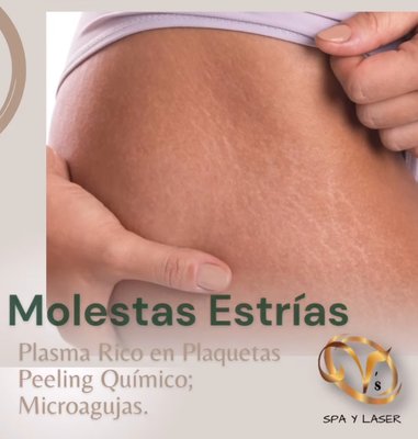 "✨ Ready to say goodbye to stretch marks? - While we can't make them vanish entirely, our specialized treatments can reduce their appearance by up to 90%! 🌟
The secret? Combining treatments for the best results! Book a free consultation based on our availability, and let’s find the perfect plan for you 🥰" "✨ Ready to say goodbye to stretch marks? - While we can't make them vanish entirely, our specialized treatments can reduce their appearance by up to 90%! 🌟
The secret? Combining treatments for the best results! Book a free consultation based on our availability, and let’s find the perfect plan for you 🥰"