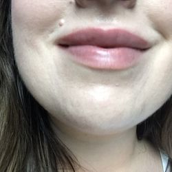 Bloom Facial Plastic Surgery - Bumps and blanching pre-HA dissolving injections -- 2 weeks post-op.
