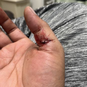 UCHealth Emergency Room - Arvada - The stitches that UCHealth said I didn't need - Medical Centers Near Me - Arvada, Colorado UCHealth Emergency Room - Arvada - The stitches that UCHealth said I didn't need - Medical Centers Near Me - Arvada, Colorado