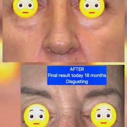 Dean G Davis, MD - Davis Facial Plastic Surgery - He hacked my nose and filled it with filler. Yes the bottom picture is the after pic. Please dont use him, you'll regret it.