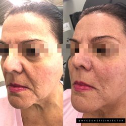 Rumor Aesthetics - Facial Filler