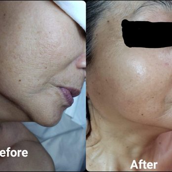 B'Esthetique - Before and After her skin tightening treatment. Improved fine lines and tightened sagging chin skin. - Estheticians Near Me - Long Beach, California