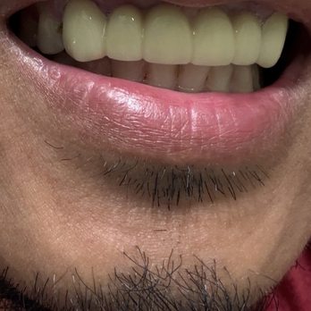 Cedar Smiles Dentistry - another after look of what they put. - General Dentistry Near Me - Bellflower, California