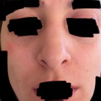 La Jolla Skin Studio - Skin before facial - Skin Care Near Me - La Jolla, California