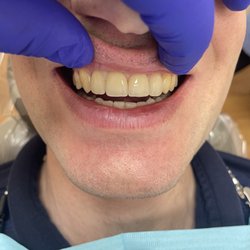 Aesthetic Dental - Porcelain crowns !