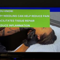 Integrative Therapies - Information on dry needling