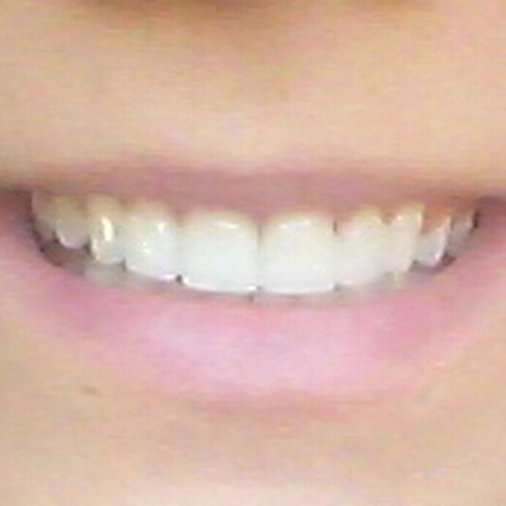 Biltmore Commons Dental Care - AFTER Veneers (front 4 only) - General Dentistry Near Me - Phoenix, Arizona Biltmore Commons Dental Care - AFTER Veneers (front 4 only) - General Dentistry Near Me - Phoenix, Arizona