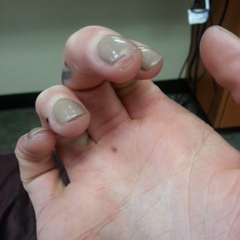 Glam Nails - The nail tech filed off my skin. This is over 4 weeks later. - Nail Salons Near Me - South Jordan, Utah Glam Nails - The nail tech filed off my skin. This is over 4 weeks later. - Nail Salons Near Me - South Jordan, Utah