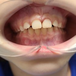 Heidi N Zuckerman, DMD - Great Neck Dentist - Another great example of the difference Dr. Heidi Zuckerman can make in your child's smile!