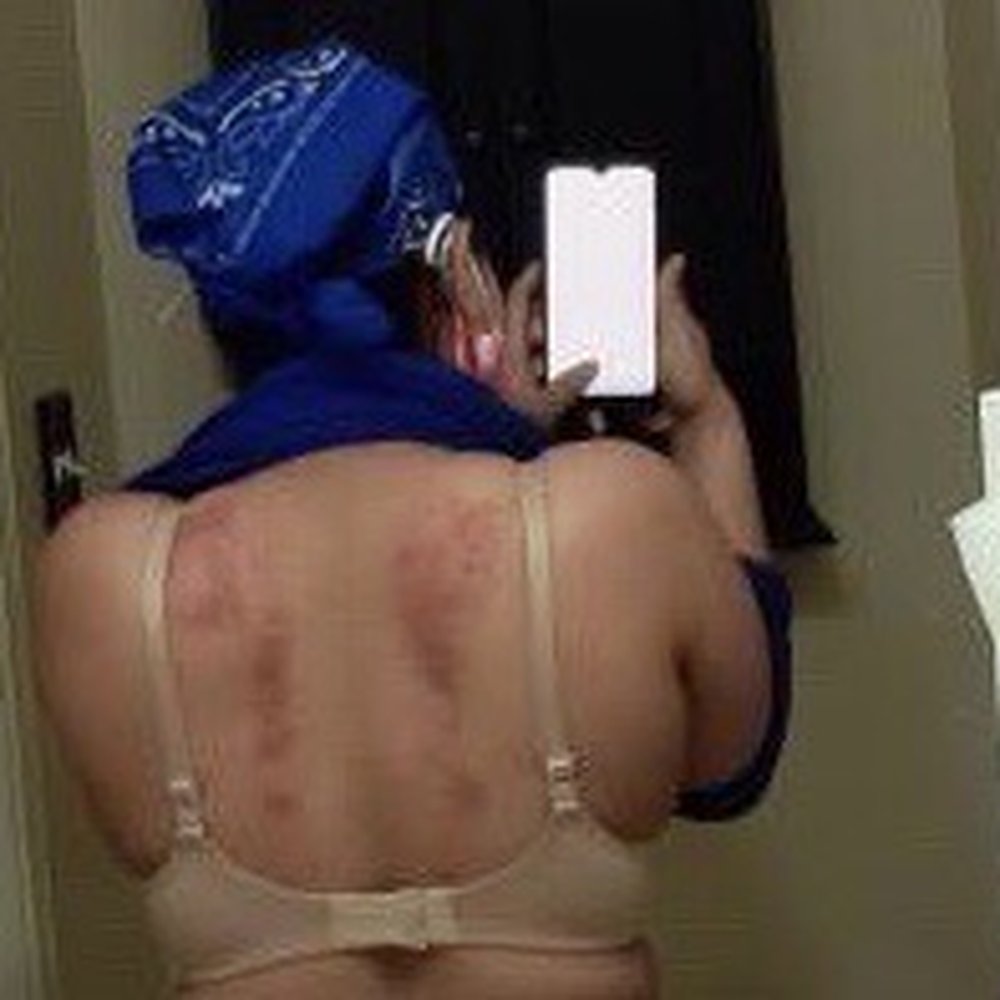 Bruises from the horrible Gua sha treatment I didn't ask for but received!