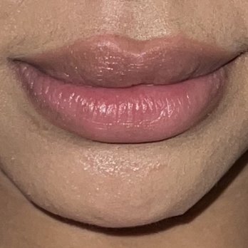 Luxe - My botched uneven lips - Medical Spas Near Me - San Jose, California Luxe - My botched uneven lips - Medical Spas Near Me - San Jose, California