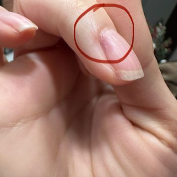 OK Nail Bar - Damaged nail after russian manicure - Nail Technicians Near Me - Los Angeles, California OK Nail Bar - Damaged nail after russian manicure - Nail Technicians Near Me - Los Angeles, California
