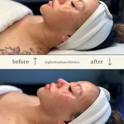 Glo Rituals - Glo Slow Hydrafacial + dermaplaning