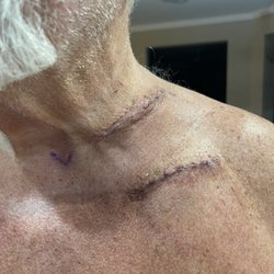 UF Health Shands Hospital - Surgery to repair an aneurysm caused by a 13th rib.