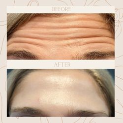 Chi Aesthetics Medspa and Wellness Center - Jeuveau injection result
