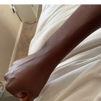 Vital Light Therapy - After a few sessions of light therapy the cyst was completely gone. - Health Coach Near Me Vital Light Therapy - After a few sessions of light therapy the cyst was completely gone. - Health Coach Near Me