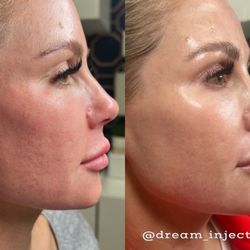 Dream Aesthetics Medspa - Skin booster injections, before and after 2 weeks. No makeup