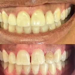 Valley Village Dentistry - A few natural looking veneers