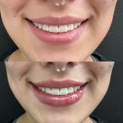 Urban Radiance - Lip filler
