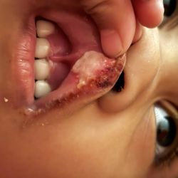 Kids Connection Dental & Braces - Damage to upper lip.