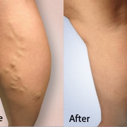 Advanced Varicose Vein Treatments of Manhattan - Untied health Care accepted/ Dr. Lev
