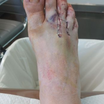 Henry Tseng, DPM - 5 days after nerouma surgery. After Dr tseng took out the two drains - Podiatrists Near Me - West Covina, California Henry Tseng, DPM - 5 days after nerouma surgery. After Dr tseng took out the two drains - Podiatrists Near Me - West Covina, California