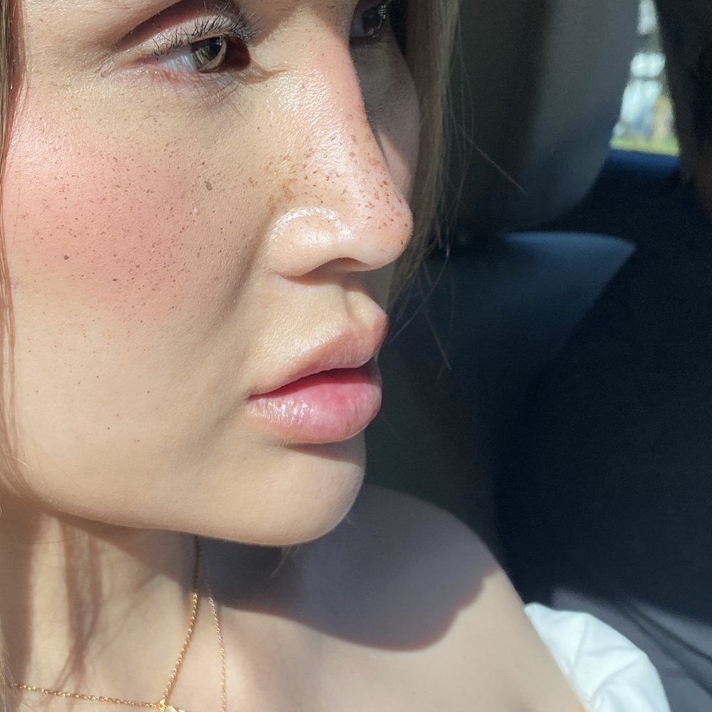 Impressions MedSpa - Cheek, chin, lip filler, and Botox brow lift - Laser Hair Removal Near Me - Fairfax, Virginia Impressions MedSpa - Cheek, chin, lip filler, and Botox brow lift - Laser Hair Removal Near Me - Fairfax, Virginia
