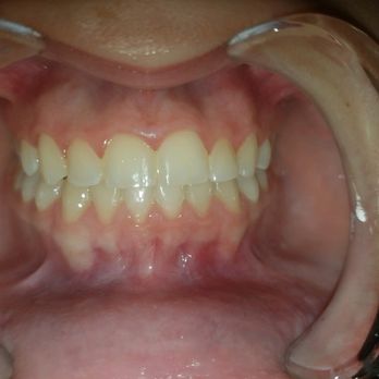 Showstoppers Teeth Whitening Studios - Teeth Whitening Near Me - Allen, Texas Showstoppers Teeth Whitening Studios - Teeth Whitening Near Me - Allen, Texas