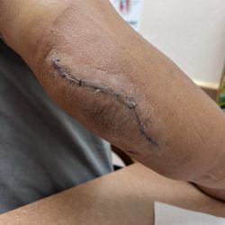 Post op stitches