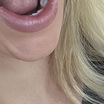 Young Family Dental - Two new crowns on my back bottom teeth. - Cosmetic Dentists Near Me - Orem, Utah Young Family Dental - Two new crowns on my back bottom teeth. - Cosmetic Dentists Near Me - Orem, Utah