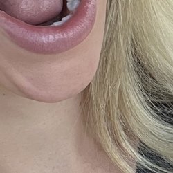 Young Family Dental - Two new crowns on my back bottom teeth.