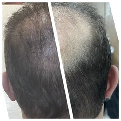Nadia Art - Scalp Micro Pigmentation