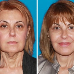 Konstantin Vasyukevich MD - Facelift Before and After Photos