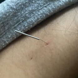 Family Healthcare Center - Needle left in my shoulder after my appointment w H Yang