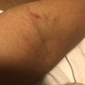 MedStar Good Samaritan Hospital - When an incompetent nurse can't draw blood. 6 sticks later. Smh - Hospitals Near Me - Baltimore, Maryland MedStar Good Samaritan Hospital - When an incompetent nurse can't draw blood. 6 sticks later. Smh - Hospitals Near Me - Baltimore, Maryland
