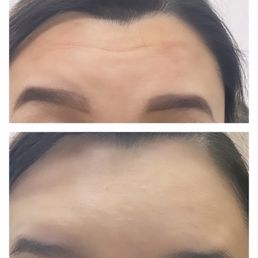 Bye forehead lines! Botox treatment before and after. I saw results within a week! Bye forehead lines! Botox treatment before and after. I saw results within a week!