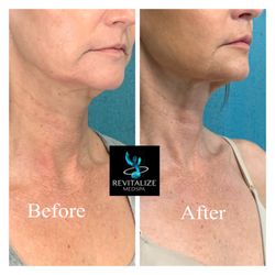Revitalize Medspa - Before/After Morpheus8 and Sculptra for lower face/jaw line, jowl improvement. Morpheus8 and Sculptra performed at Revitalize Medspa