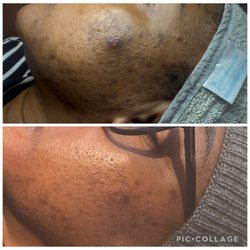 Secrets of Beauty Skin & Body - Beautiful progress after one vipeel.