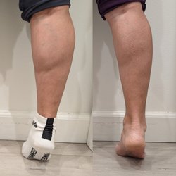 Calf Reduction by Botox Injections