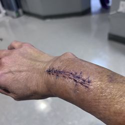 High Desert Orthopedics - Photo of my wrist after plate and screws were removed from current surgeon (2nd surgery)