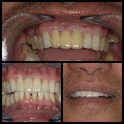 Chad Lyew, DDS - Alemany Dental - New front porcelain bridge