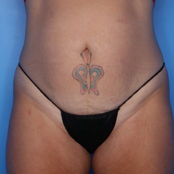 Setty Plastics and Aesthetics - Before - Cosmetic Surgeons Near Me - McKinney, Texas